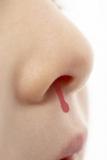 Le nez qui saigne, que faire? Le nez qui saigne, que faire?